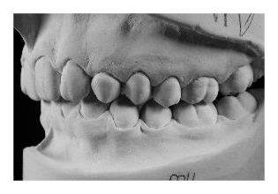 Eckzahnretention (Korrektur von Zahnfehlstellung und Kieferfehlstellung bei Erwachsenen)