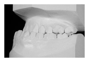 Kombiniert kieferorthopädisch-kieferchirurgische Behandlung (Korrektur von Zahnfehlstellung und Kieferfehlstellung bei Erwachsenen)