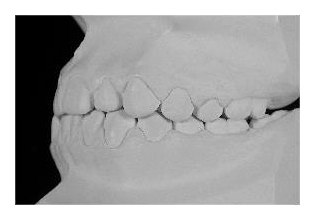 Frontzahnextraktion im Unterkiefer (Korrektur von Zahnfehlstellung und Kieferfehlstellung bei Kindern & Jugendlichen)