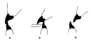 Frontzahnstufe = Overjet