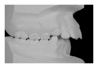 Frontzahnstufe (Korrektur von Zahnfehlstellung und Kieferfehlstellung bei Kindern & Jugendlichen)