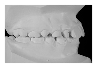 Nichtanlage eines seitlichen Schneidezahns (Korrektur von Zahnfehlstellung und Kieferfehlstellung bei Kindern & Jugendlichen)