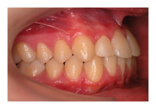 Nichtanlage eines seitlichen Schneidezahns (Korrektur von Zahnfehlstellung und Kieferfehlstellung bei Kindern & Jugendlichen)