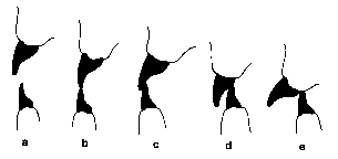 Tiefbiss = Overbite