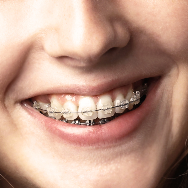 Keramikbrackets